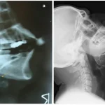 رادیولوژی سیالوگرافی