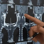 سی تی آنژیوگردن و عروق گردنی